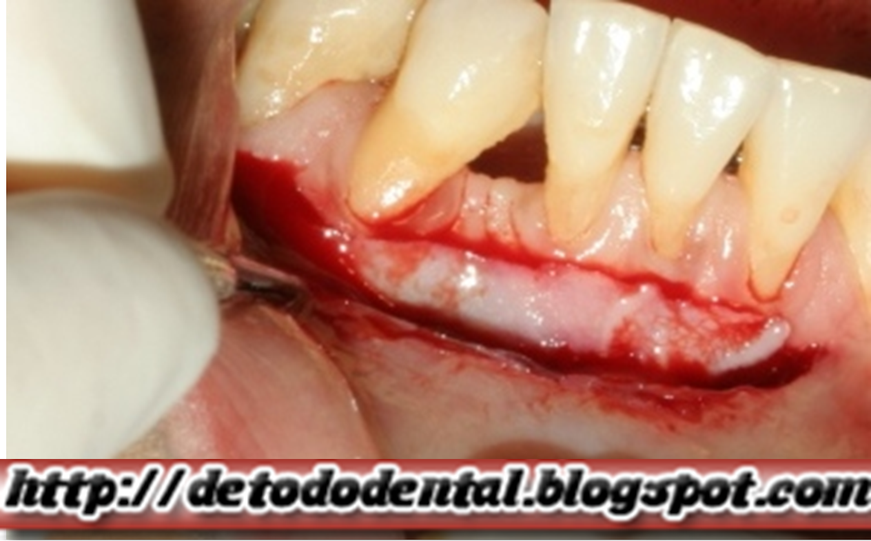 Porque sangre 10 dias despues de mi periodontal Porque sangre 10 dias despues de mi periodontal
